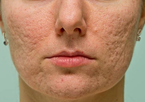 Frontal view of girl's cheeks and chin with acne scars